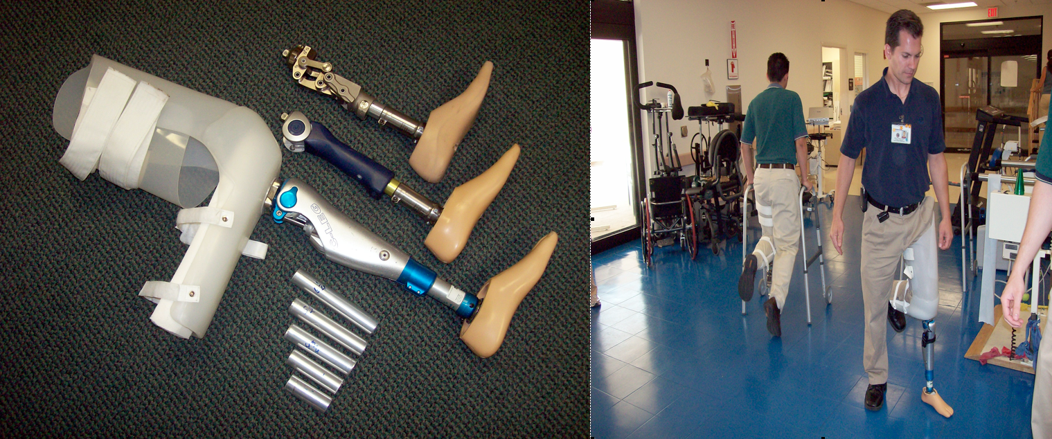 Lower Limb Prosthetic Experience